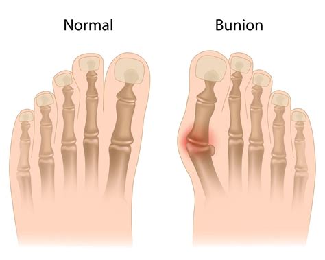 Bunions Cause Toe Problems | Syracuse Podiatry - Dr. Ryan D'Amico