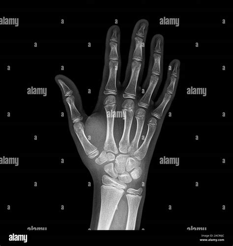 X Ray Broken Wrist Hand And Wrist Fractures – Undergraduate