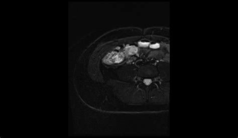 Image result for Normal Appendix MRI