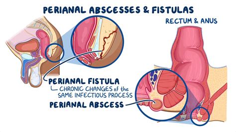 Ischiorectal Abscess Fistula In Ano