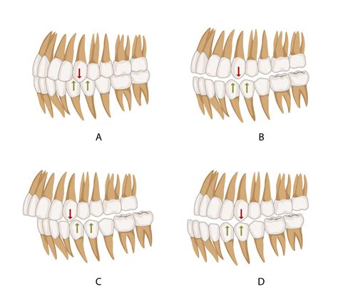 Dental Occlusion | Geeky Medics