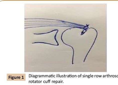 Image result for Single Row Rotator Cuff Repair