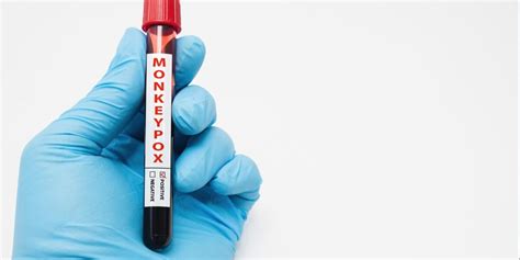 Infectious disease doctor discusses Kansas’ 1st case of monkeypox