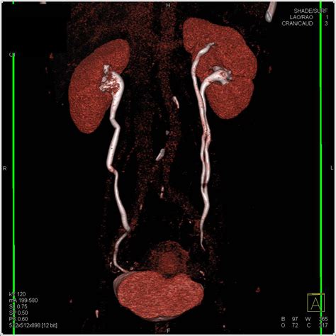 CT Urogram with Duplicated Collecting System on the Left - Kidney ...