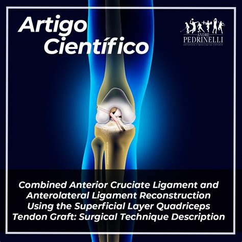 Combined Anterior Cruciate Ligament and Anterolateral Ligament Reconstruction Using the ...