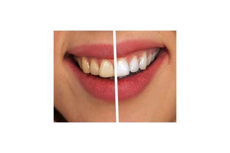 Brushing your teeth, hygiene, whitening in Dentistry «Denta.UA»