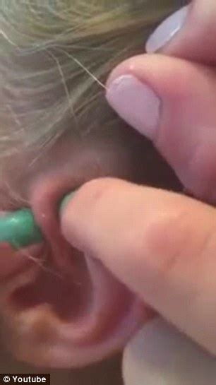 Image result for Loud Exploding Zit