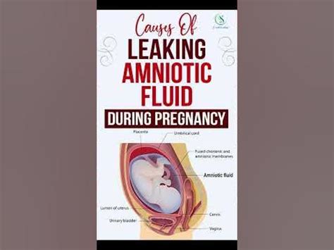 Causes Of Leaking Amniotic Fluid During Pregnancy #pregnancy # ...
