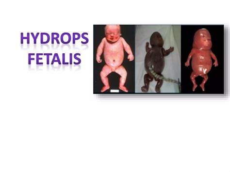 hydrops%20fetalis.pptx