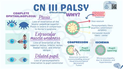 CN III Palsy — Neudrawlogy: Simplifying Neurology