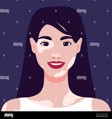Beautiful smiling young woman with vitiligo depigmentation. Rare appearance. Portrait or an ... - how rare is vitiligo