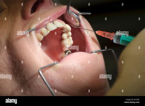 Infiltration Anesthesia Dental Lower 的图像结果
