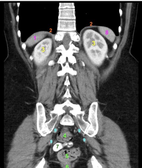 Image result for Normal Appendix Coronal