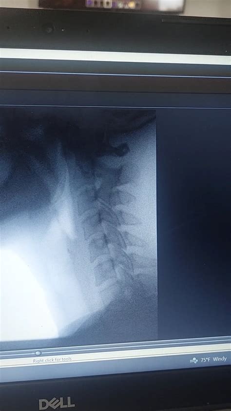 Image result for Modified Barium Swallow Video Example