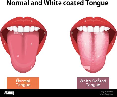 Tongue’s health sign vector illustration ( White coated tongue Stock Vector Image & Art - Alamy
