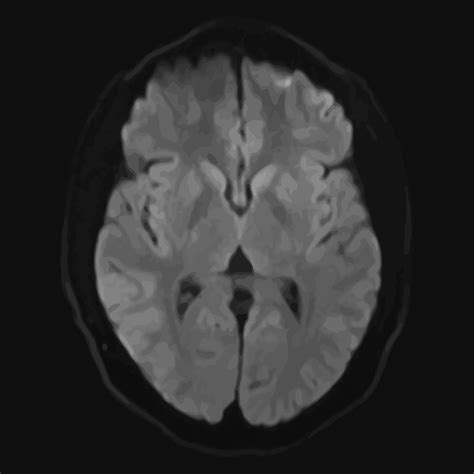 Realistic axial image of male cerebrum with CT scan, MRI Magnetic resonance imaging layer of ...