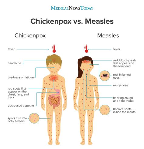 Chickenpox Vs Measles - Maple Leaf Medical Centre, Edgars Road Thomastown