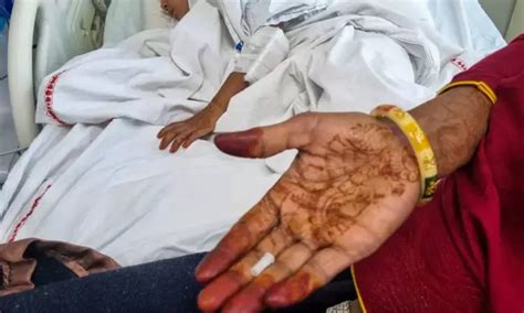 AIIMS doctors remove whistle stuck in windpipe of 4-year-old through ...