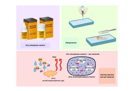 Zinc-Based Dental Cements: Properties, Applications – Medi Study Go