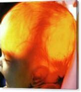 Image result for Transillumination Normal Head