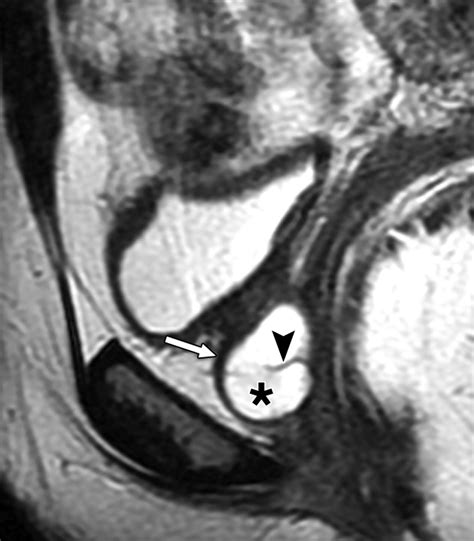 Pre- and Postoperative Evaluation of Urethral Diverticulum | AJR