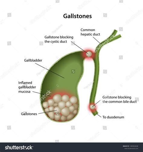 Gallstones Gallbladder Description Corresponding Parts Isolated: vector de stock (libre de ...