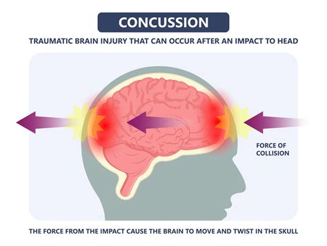 Concussion - Osteopathic Treatment Vaughan | Osteoklinika Canada