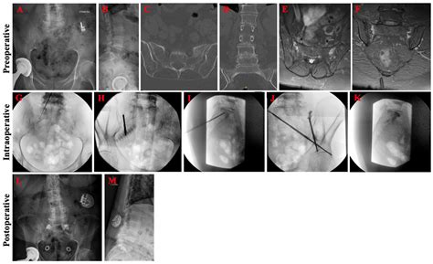 Sacroplasty for Sacral Insufficiency Fractures: Narrative Literature Review on Patient Selection ...