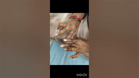 Image result for Hand Dysfunction