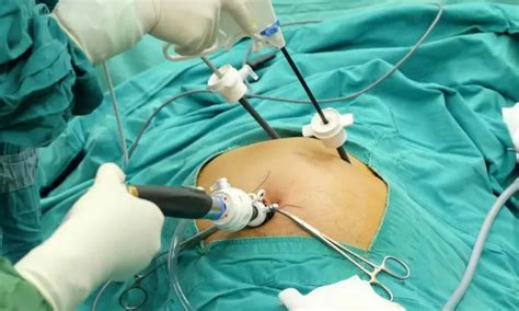 Single-Incision Laparoscopic Cholecystectomy Safe, Feasible, and ...