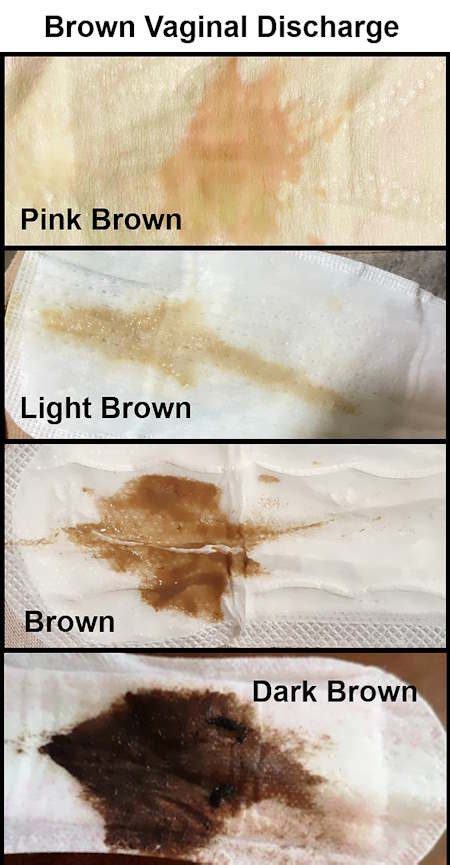 What Does Brown Discharge Mean? Common Causes & When to See a Doctor