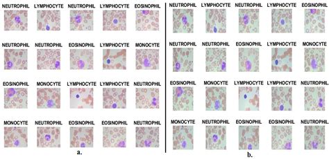 Recuento De Glóbulos Blancos (wbc): Significado, Síntomas Y Tratamiento | Botoxina