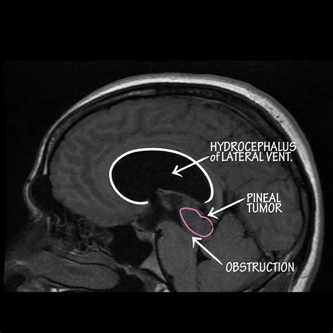 Neuroanatomy Glossary: Hydrocephalus: Obstructive | ditki medical ...