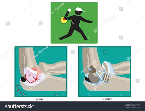 Ulnar Collateral Ligament Tommy John Injury Stock Vector (Royalty Free) 1993590554 | Shutterstock