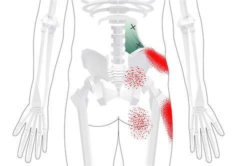 Quadratus Lumborum Trigger Points Masters Of Low Back 63 Best Trigger ...