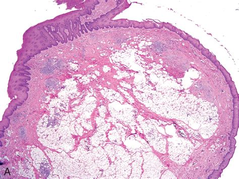 Tumors of the Esophagus - Clinical Tree