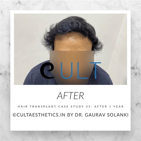 Hair Transplant Case Study 35 | Cult Aesthetics