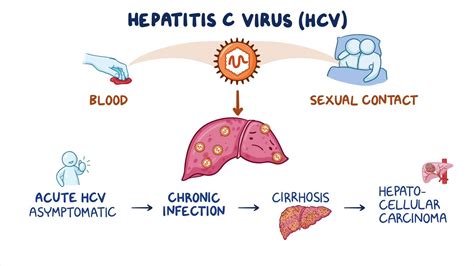 Video: Hepatitis C: Clinical sciences | Osmosis