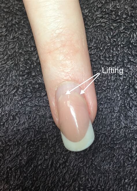 Nail Lifting From Nail Bed