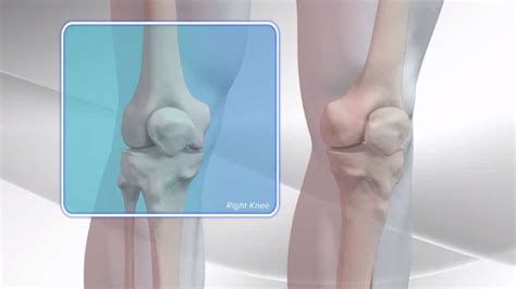 Knee Replacement Recovery 的图像结果