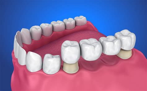 Fixed Bridge Dental