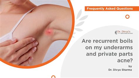 Exploding Armpit Zits 的图像结果