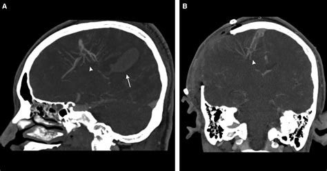 COVID-19-Associated Cerebral Developmental Venous Anomaly Thrombosis With Hemorrhagic ...
