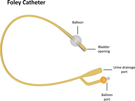 Induction Methods - Balloon Catheter | Back to Basics Birthing