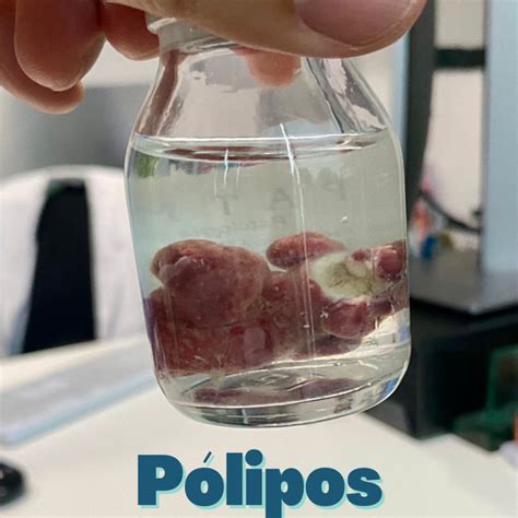 PÓLIPOS DEL COLON - Clínica Digestiva