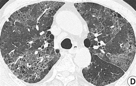 Low- and conventional-dose TMP-SMX combo equally effective in ...