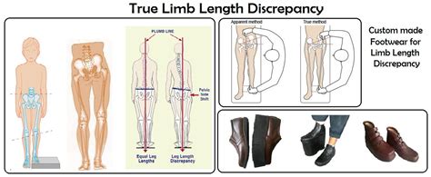 Measure Leg Length Discrepancy 的图像结果