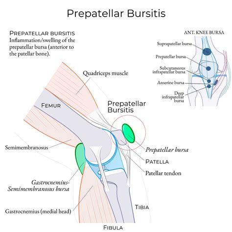 Clinical Medicine Glossary: Prepatellar bursitis | ditki medical & biological sciences