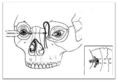 Image result for Transnasal Loop Fixation