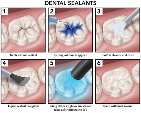 Dentist Sealant Teeth